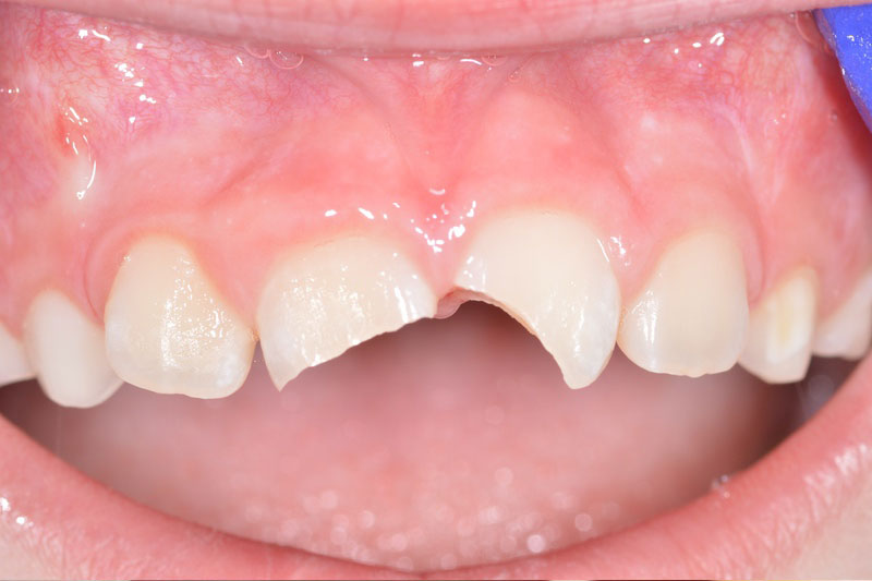 1 Caso1 Fratture Margini Incisali